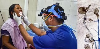 ബ്ലാക്ക് ഫംഗസ് ; പശ്ചിമ ബംഗാളിൽ ആദ്യ മരണം റിപ്പോർട്ട് ചെയ്തു ബ്ലാക്ക് ഫംഗസ്