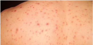 ജി​ല്ല​യി​ല്‍ ത​ക്കാ​ളിപ്പ​നി പ​ട​രു​ന്നു