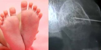 കുഞ്ഞിന്‍റെ കാലില്‍ സൂചി ഒടിഞ്ഞ് തറച്ചു