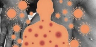 മങ്കിപോക്സ് കൊവിഡിൽ നിന്നും വ്യത്യസ്തം