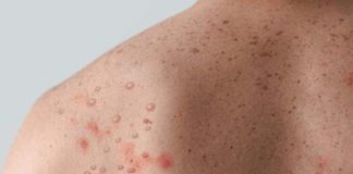 സംസ്ഥാനത്ത് ഒരാള്‍ക്ക് കൂടി കുരങ്ങുവസൂരി